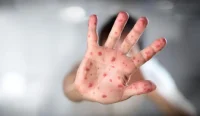 Dinas Kesehatan Balangan mencatat 30 kasus positif campak Balangan dari hasil uji laboratorium terhadap 71 sampel praduga yang pihaknya kirimkan sejak awal tahun hingga April 2026.